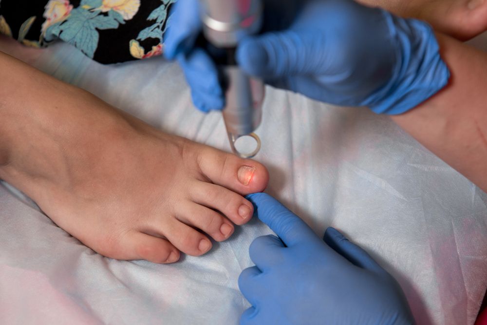 Exploring Feet and Nail Fungus Doctor Laser Treatments