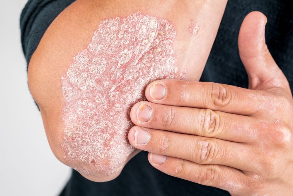 Key Insights into Plaque Psoriasis and Its Triggers