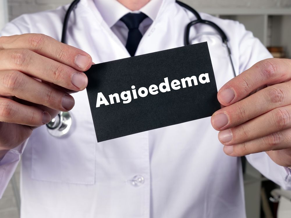 What Causes Angioedema Swelling and How to Manage It?