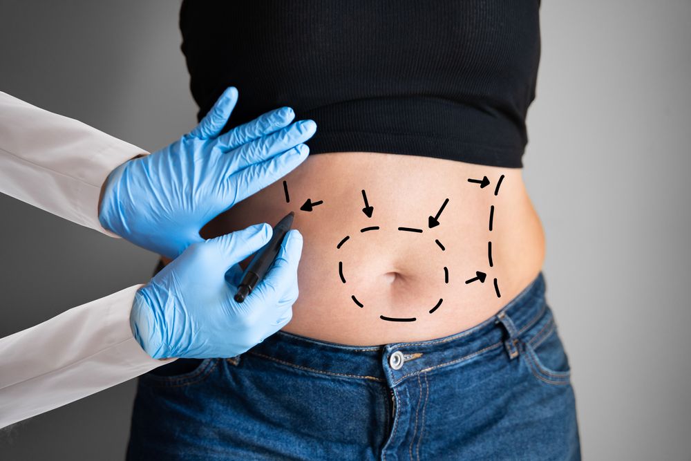 Guía para Explorar los Beneficios de los Ensayos de Abdominoplastia 2025