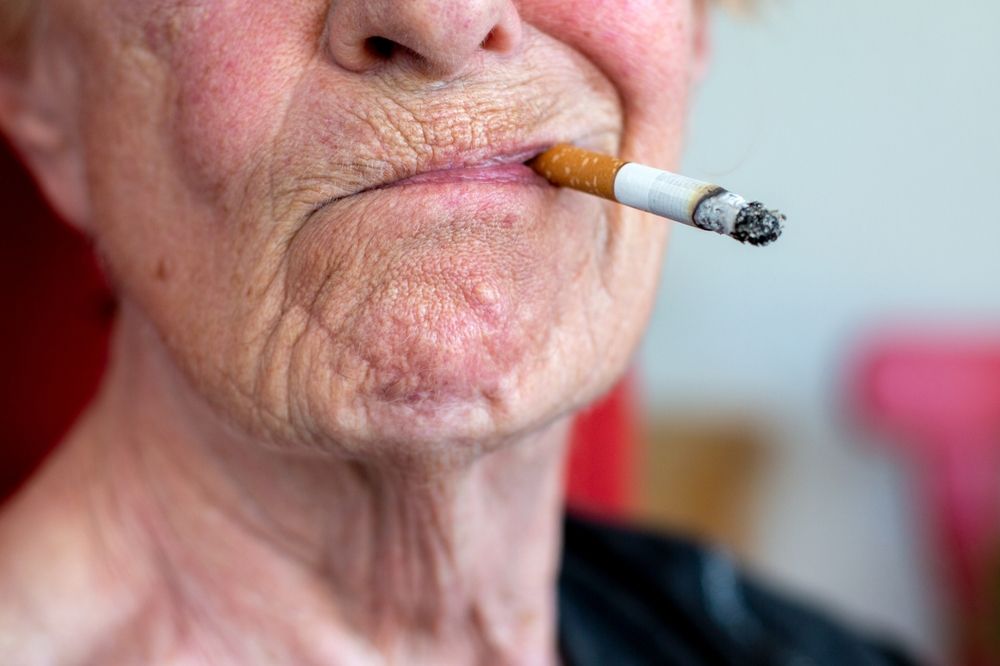 Best Laser Treatments for Smokers Lines