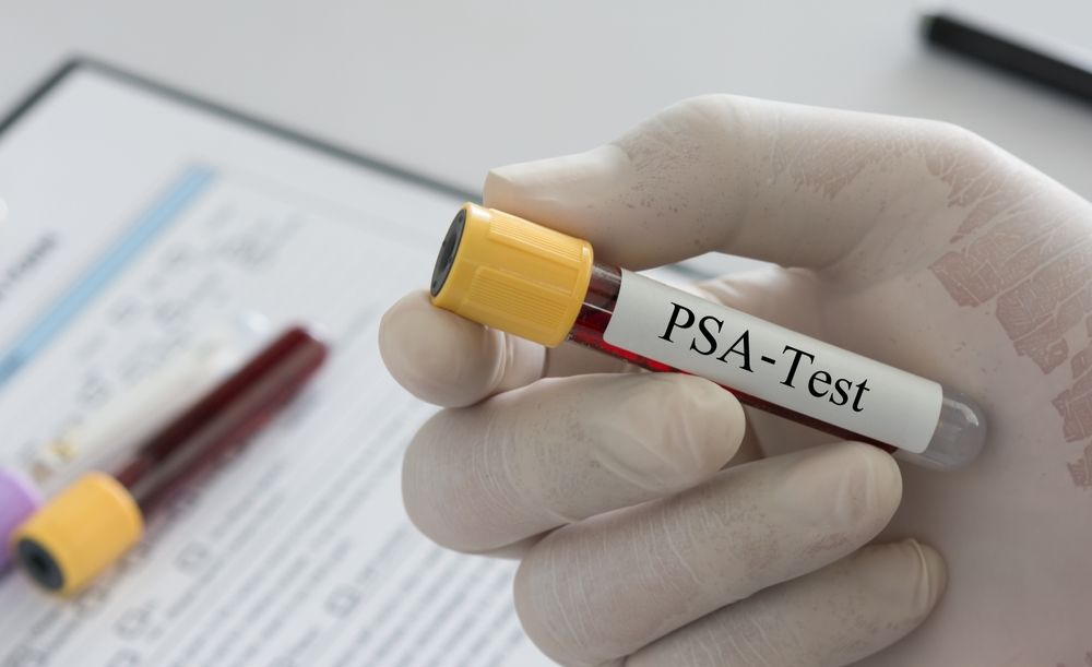 PSA Tests: Things Every Guy Needs to Know