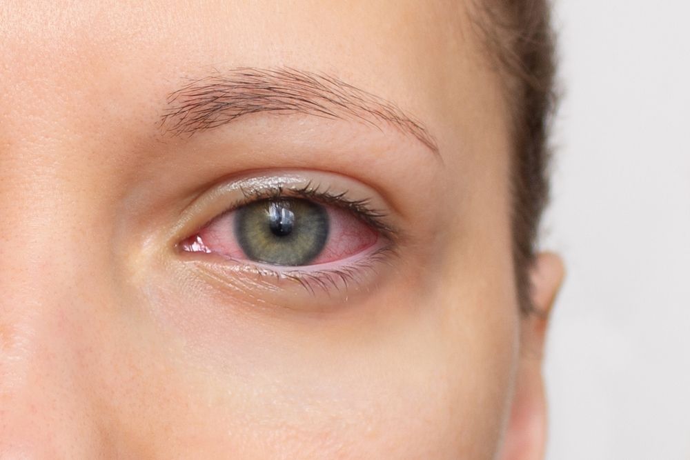 Understanding Thyroid Eye Disease: symptoms, Signs, and Treatment Options