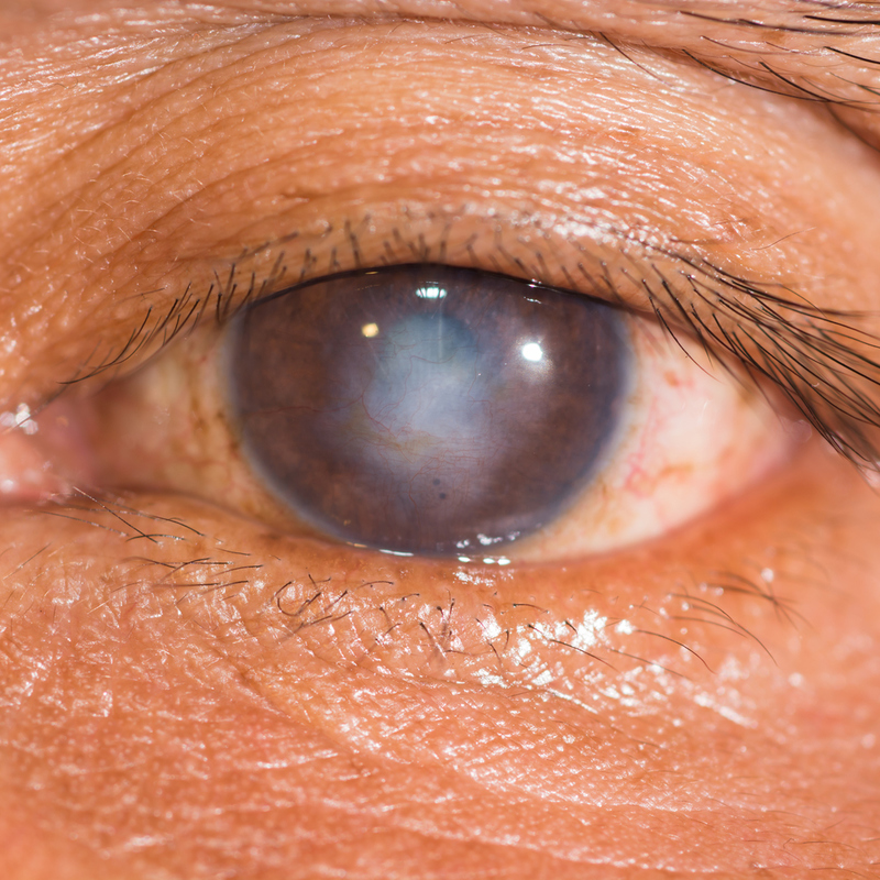 La cicatriz de un globo ocular | ARZTSAMUI/Shutterstock