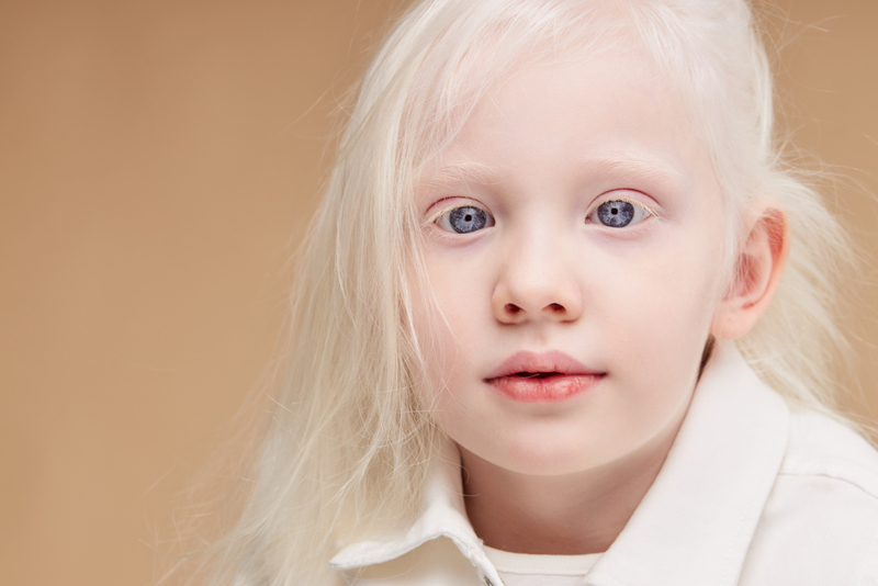 Okulärer Albinismus bedeutet mehr als nur eine Reduzierung der Pigmentierung | UfaBizPhoto/Shutterstock